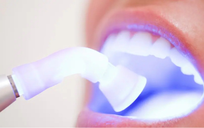LASER Teeth Whitening LASER Teeth Whitening