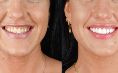 Lip repositioning Lip repositioning