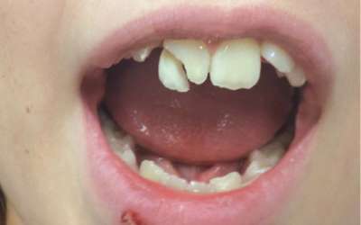 dental fracture management